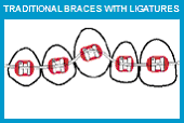 traditional braces